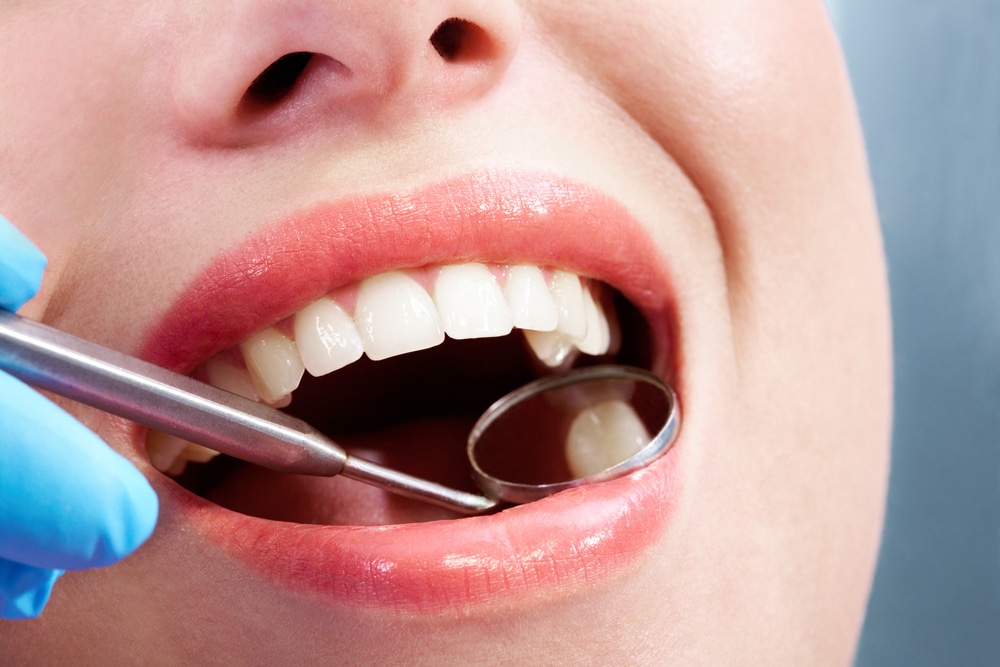 Fillings in Wilmington, Delaware