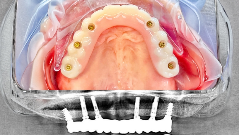 After_Maxilla(Top)_Case3 Andres Hurtado, DDS (1) Inicio