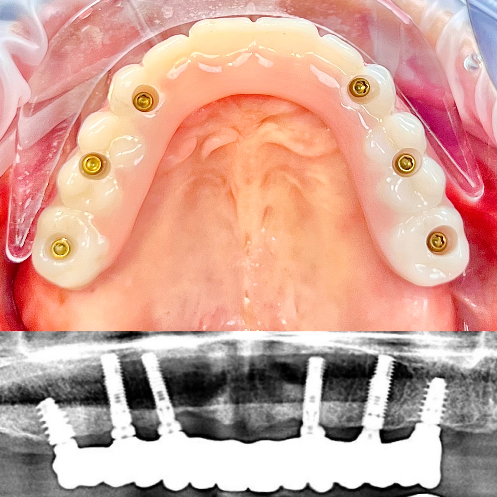 Before and After Image: Maxilla - front