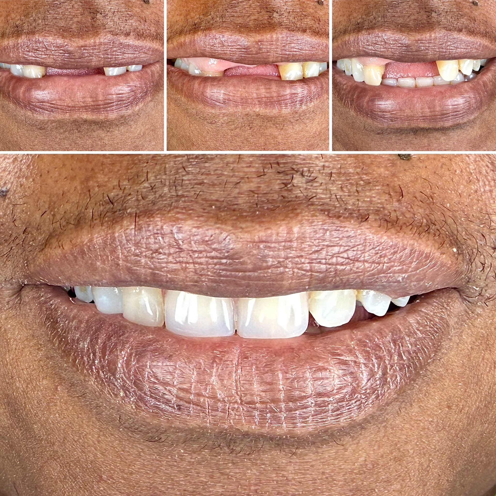 Before and After Image: Implants - front