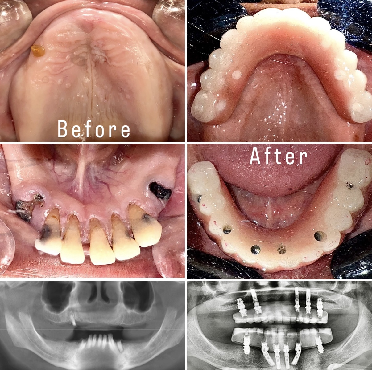 Before and After Image: Full Mouth Reconstruction - front
