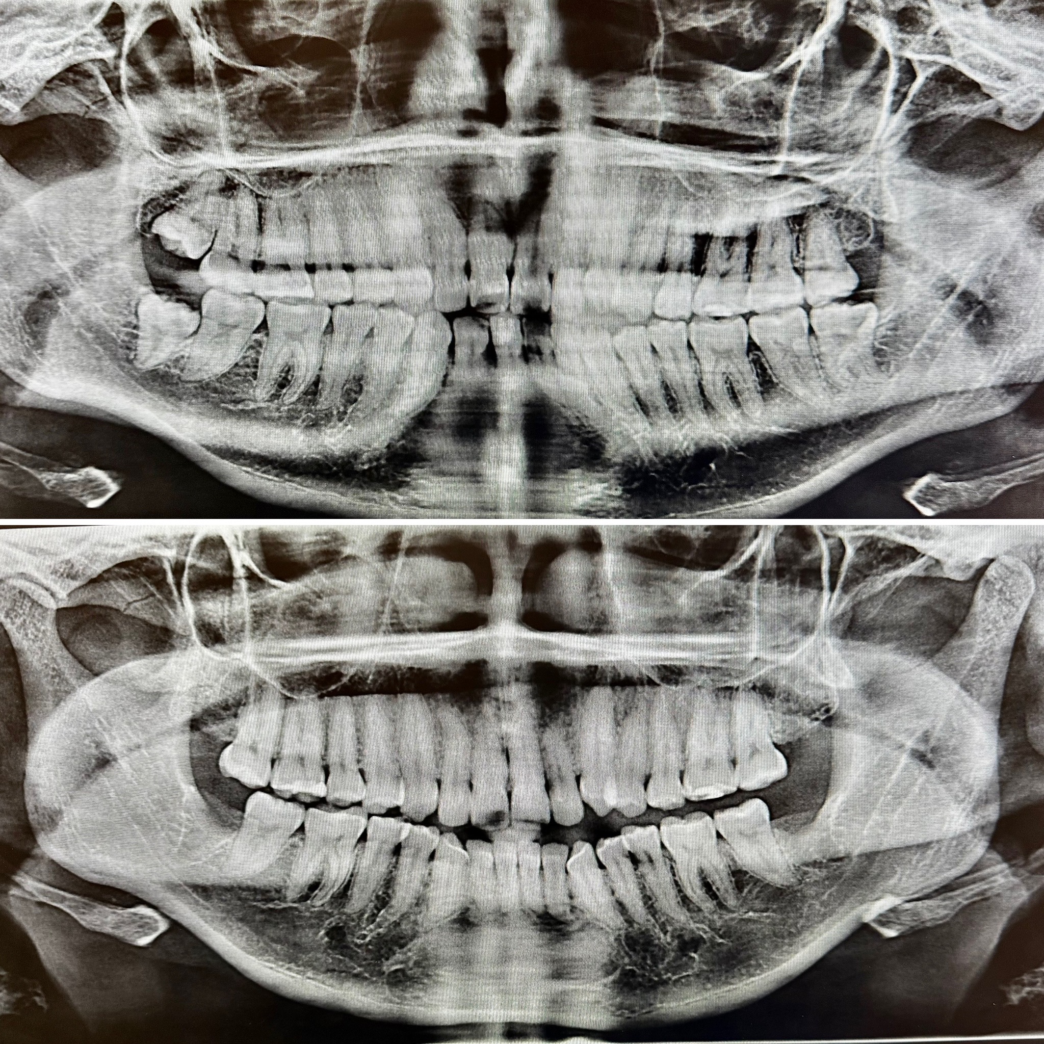 Before and After Image: Wisdom Teeth - front