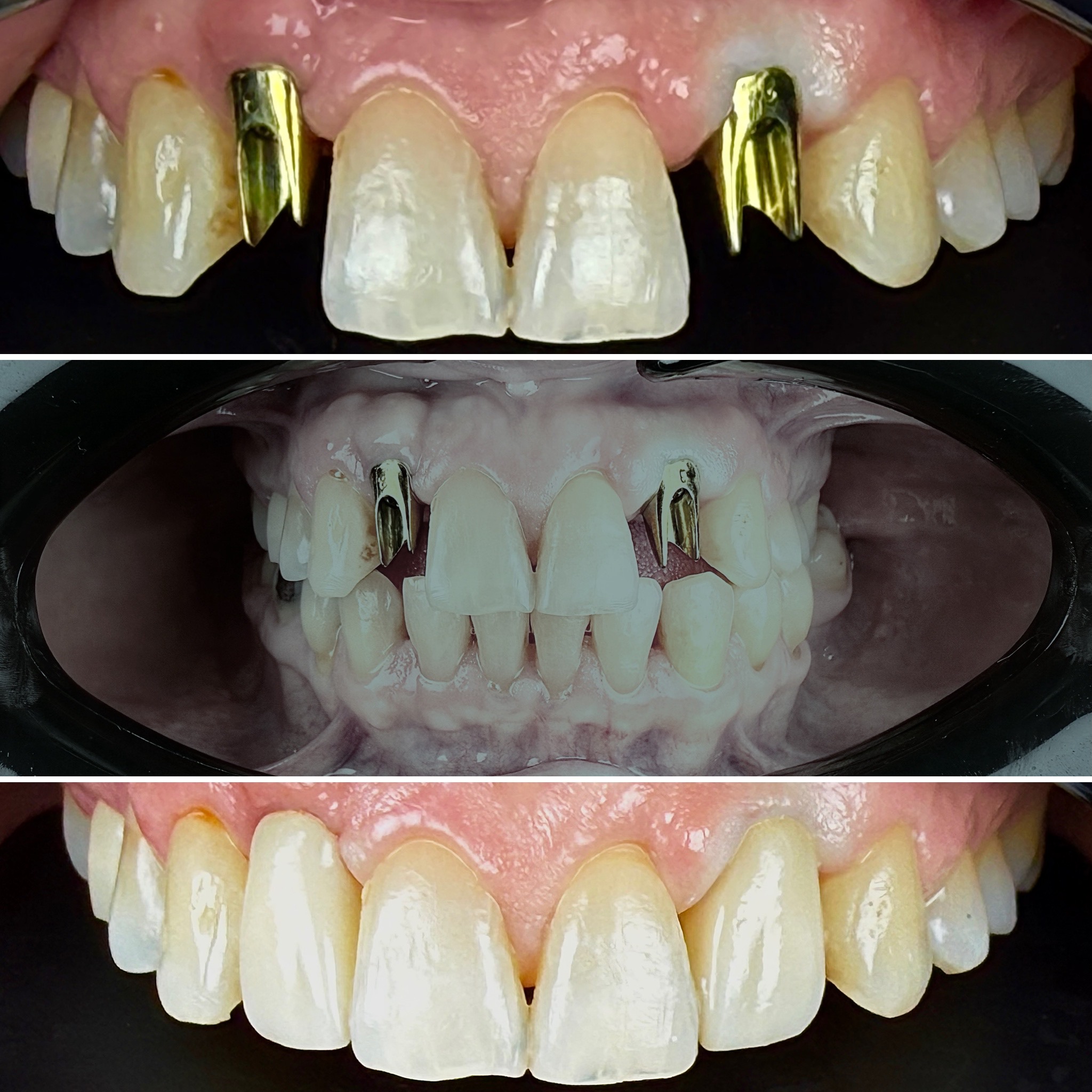Before and After Image: Implants - front