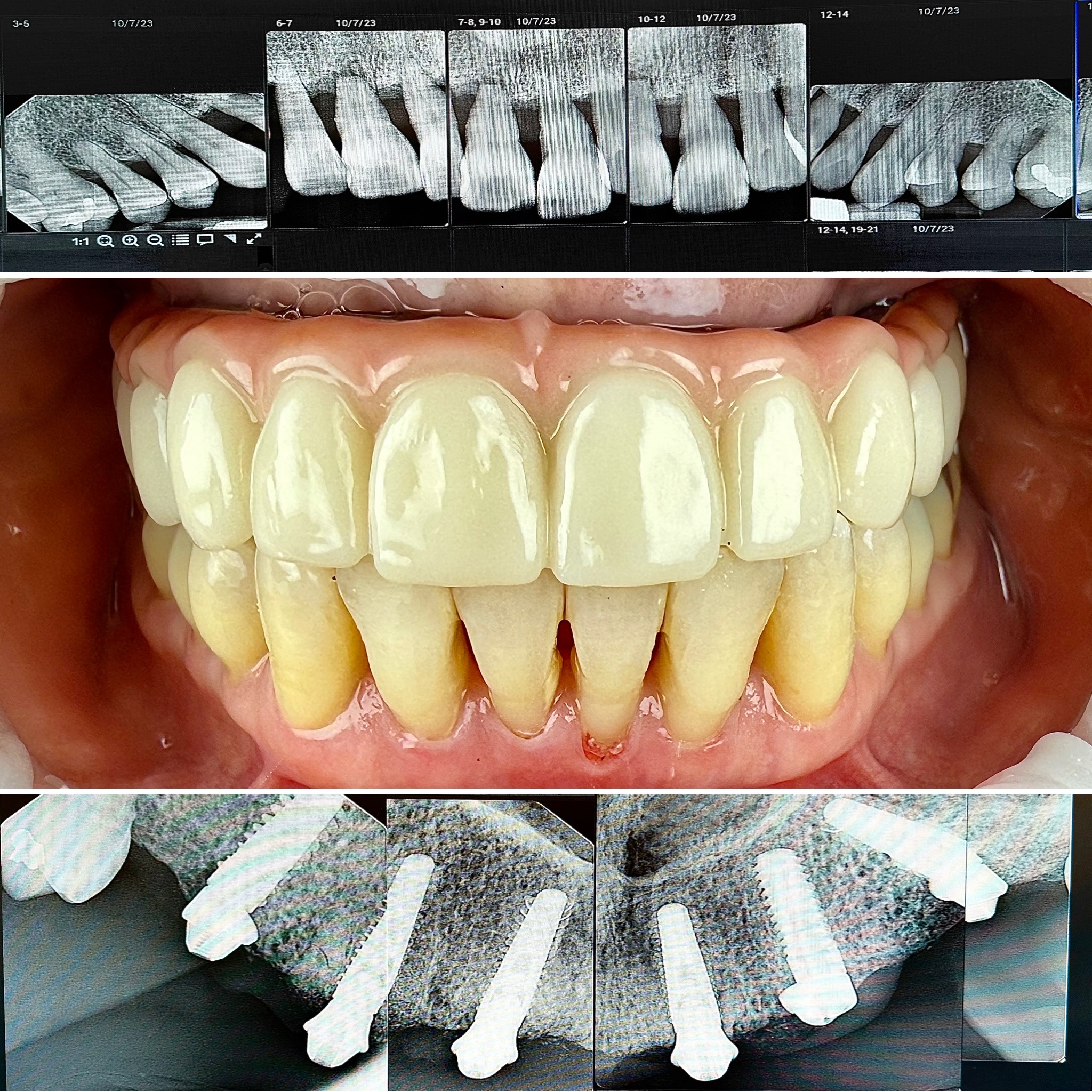 Before and After Image: Top X-rays – Final Middle And Bottom - front