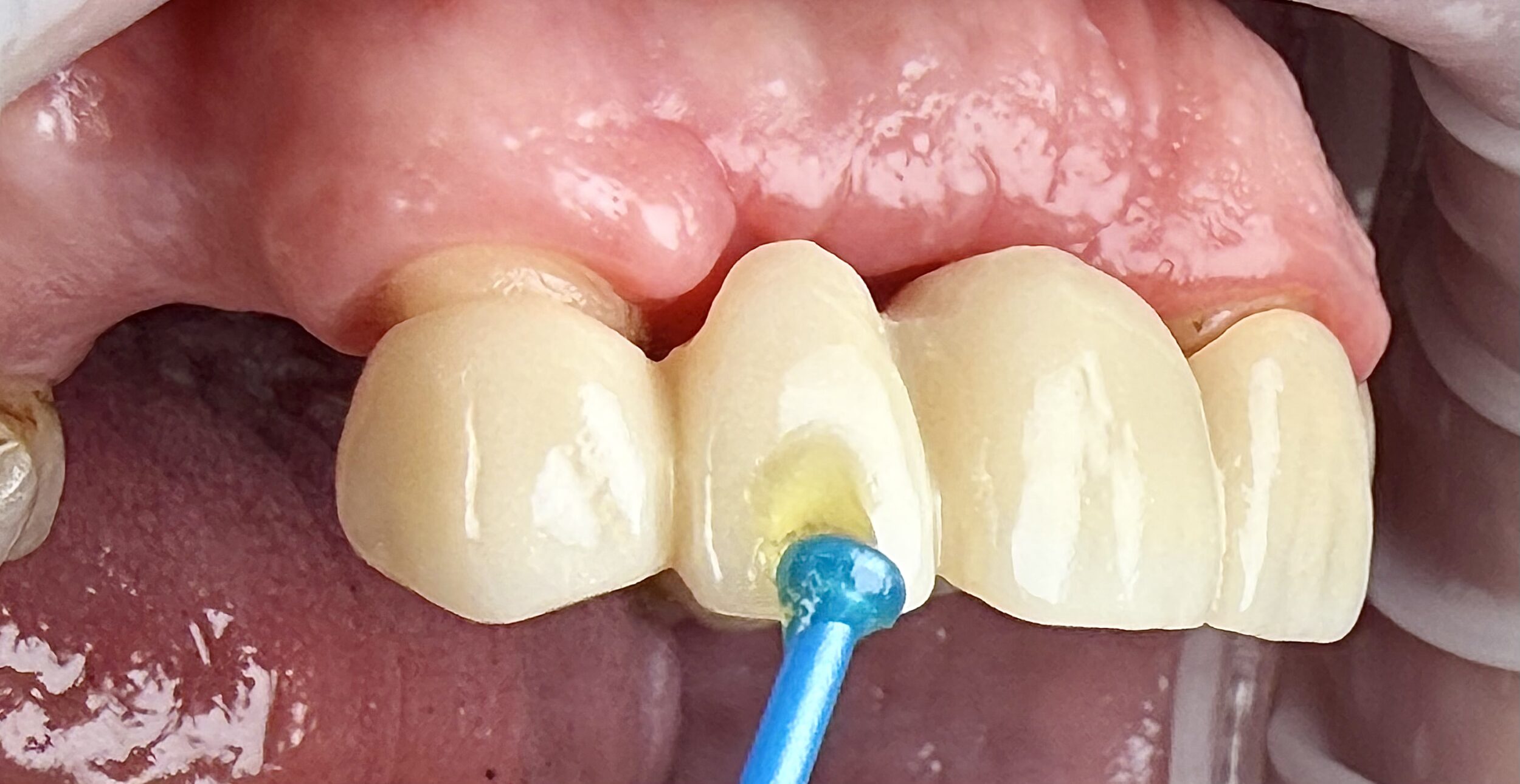 Before and After Image: Bridge - right-front-oblique