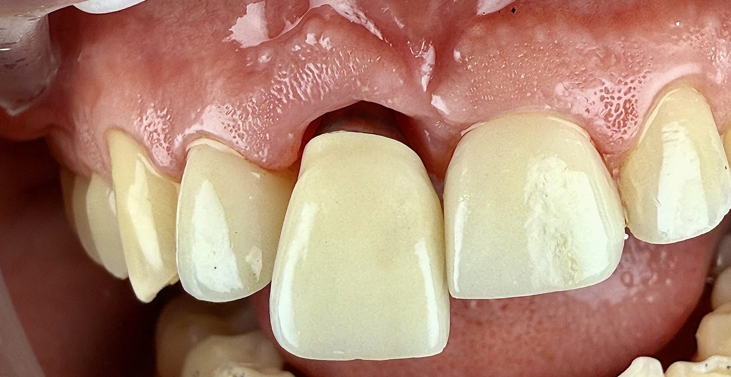 Before and After Image: Crowns from Implants - front