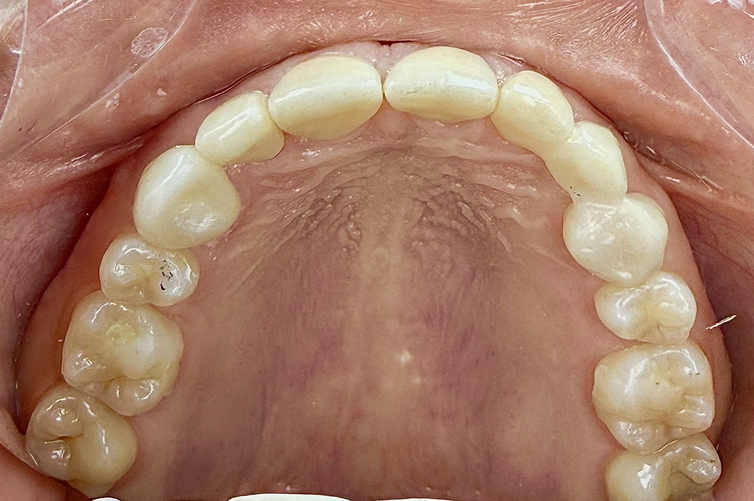 Before and After Image: Crowns - front