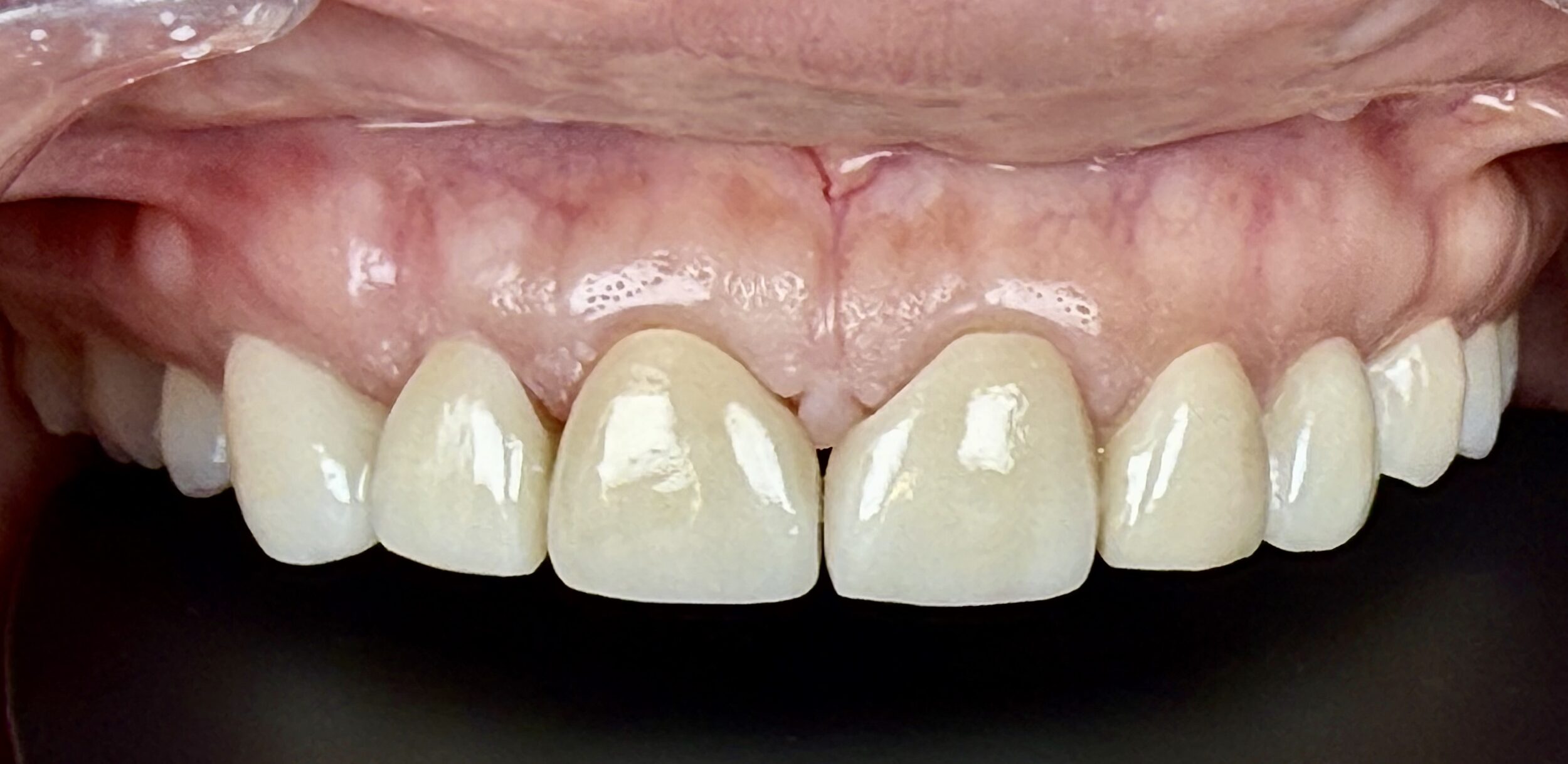 Before and After Image: Crowns - front