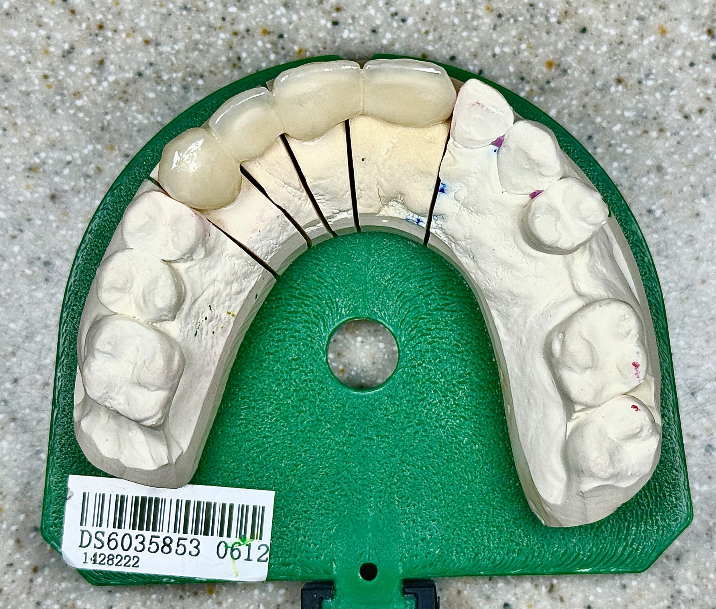 Before and After Image: Crowns - front
