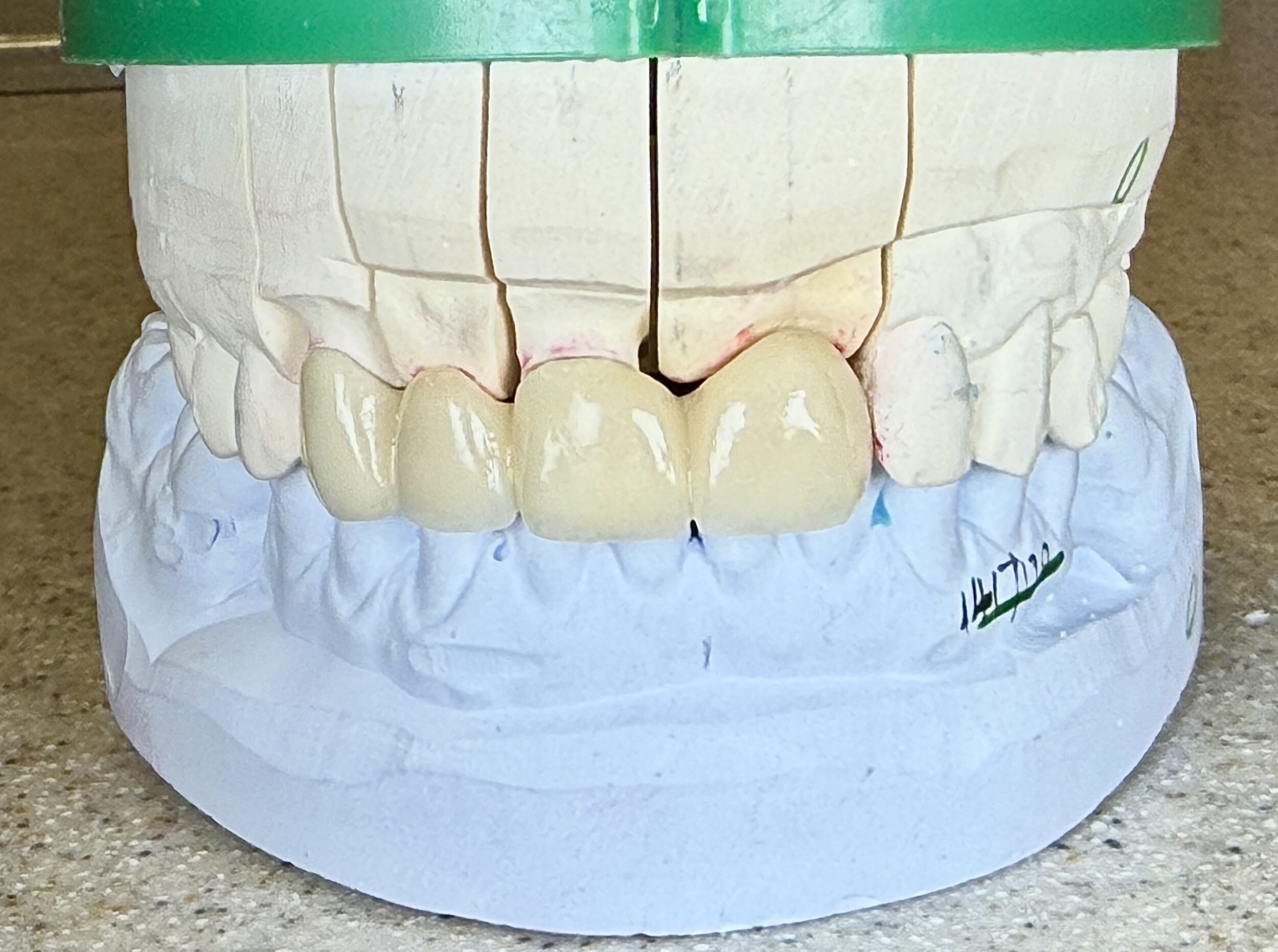 Before and After Image: Crowns - front