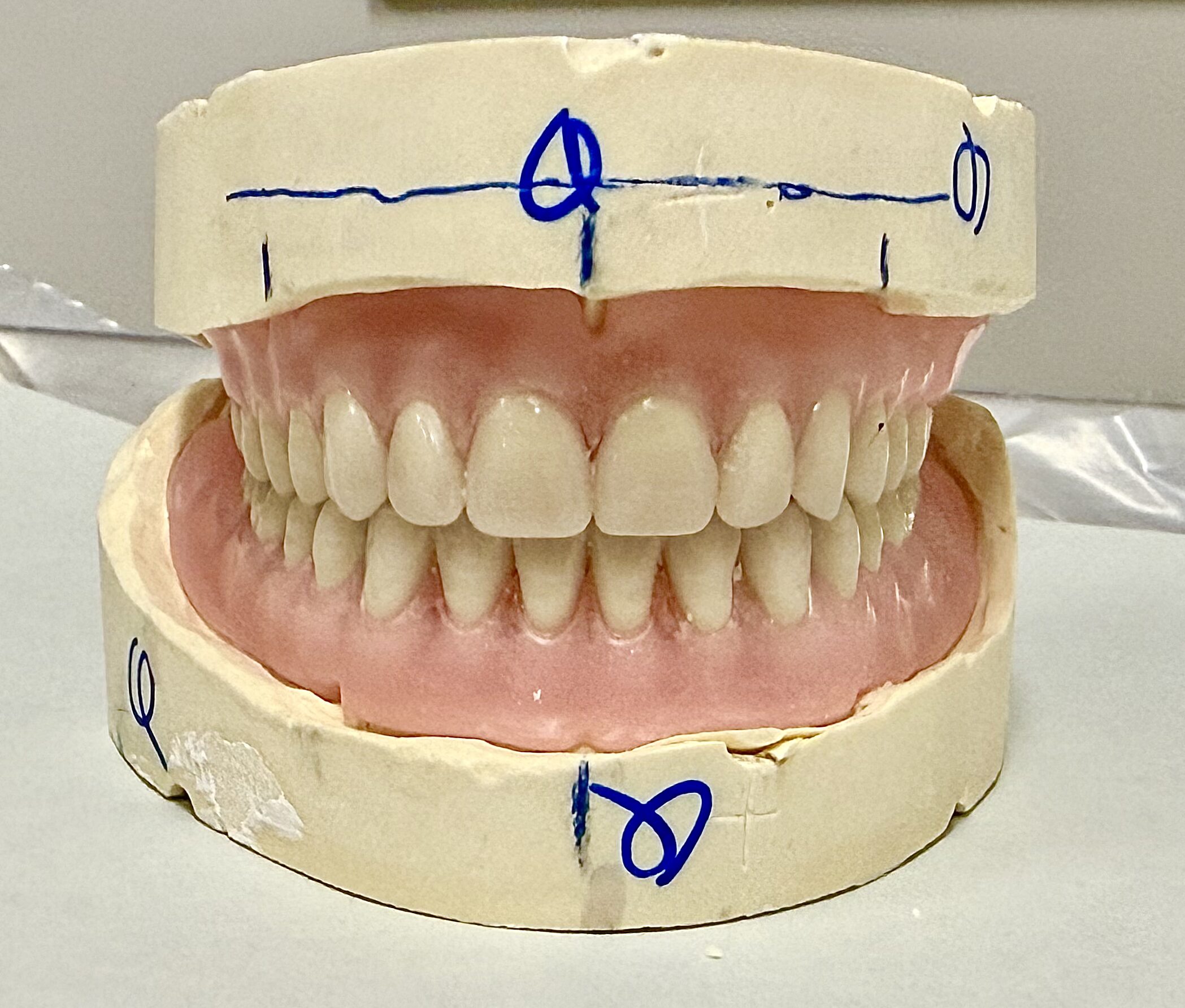 Before and After Image: Dentures - front