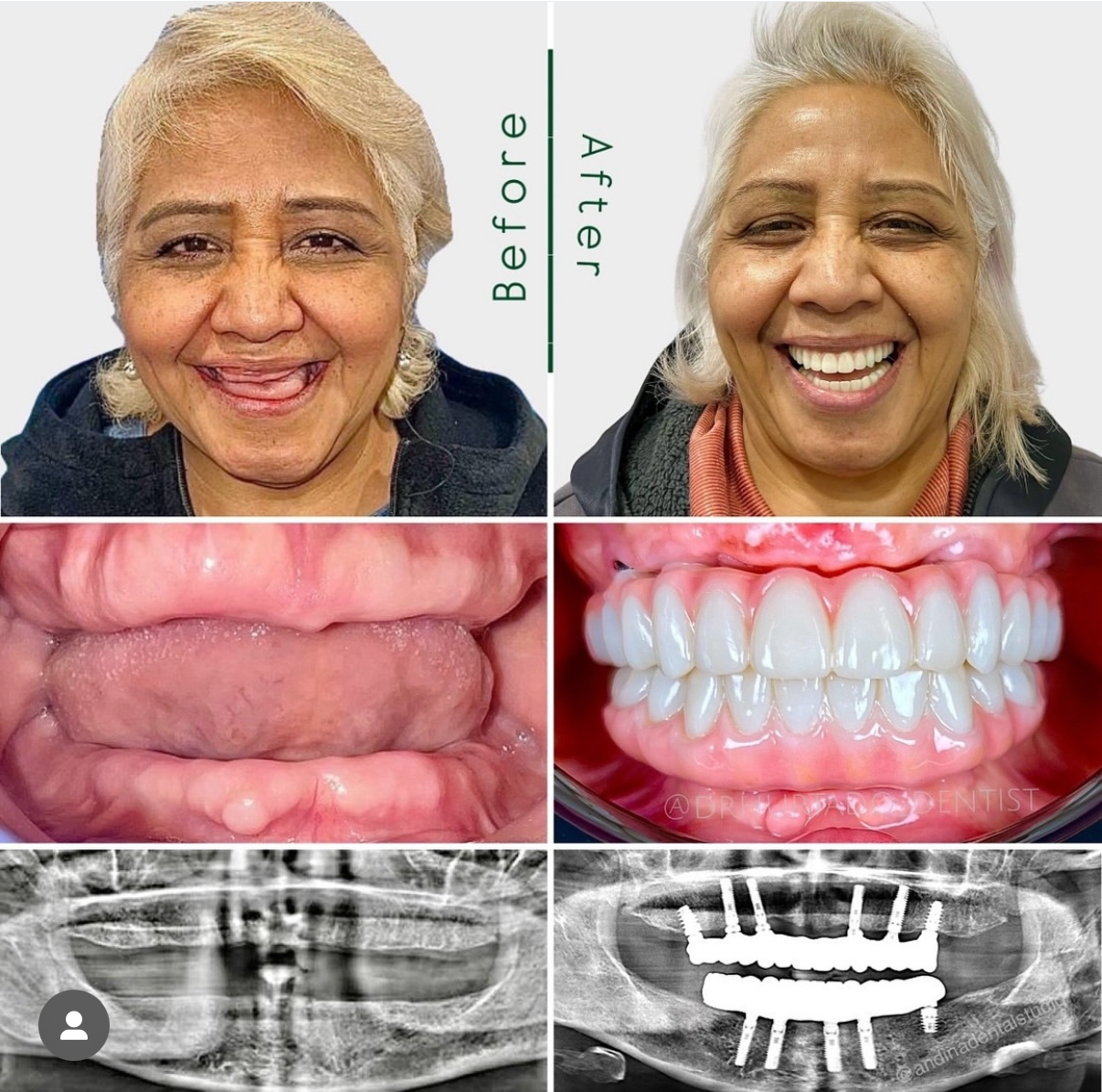 Before and After Image: Full Mouth Reconstruction with Implants - front