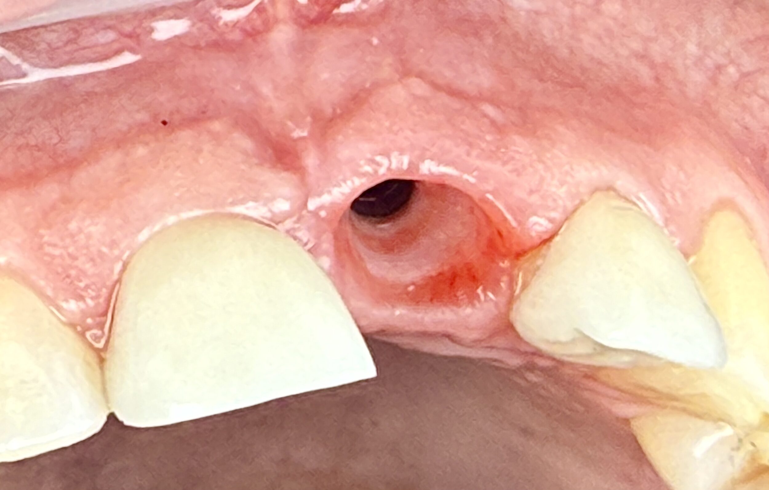 Before and After Image: Gums from an Implant - front