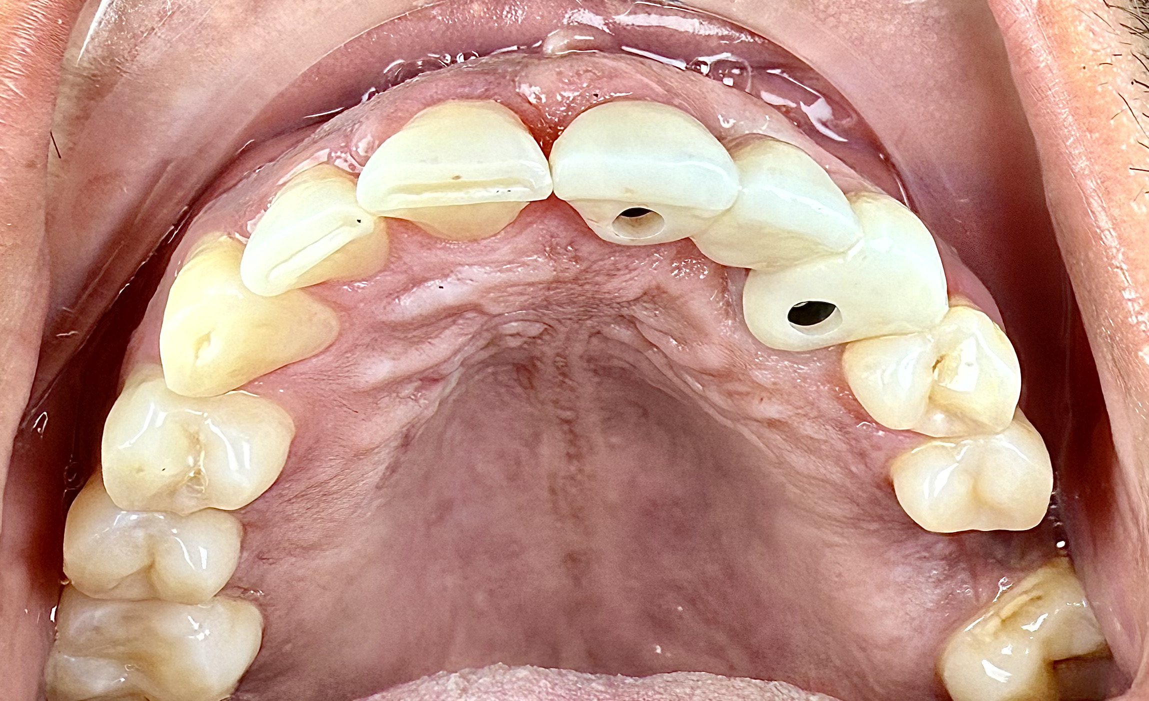 Before and After Image: Implant Bridge - front