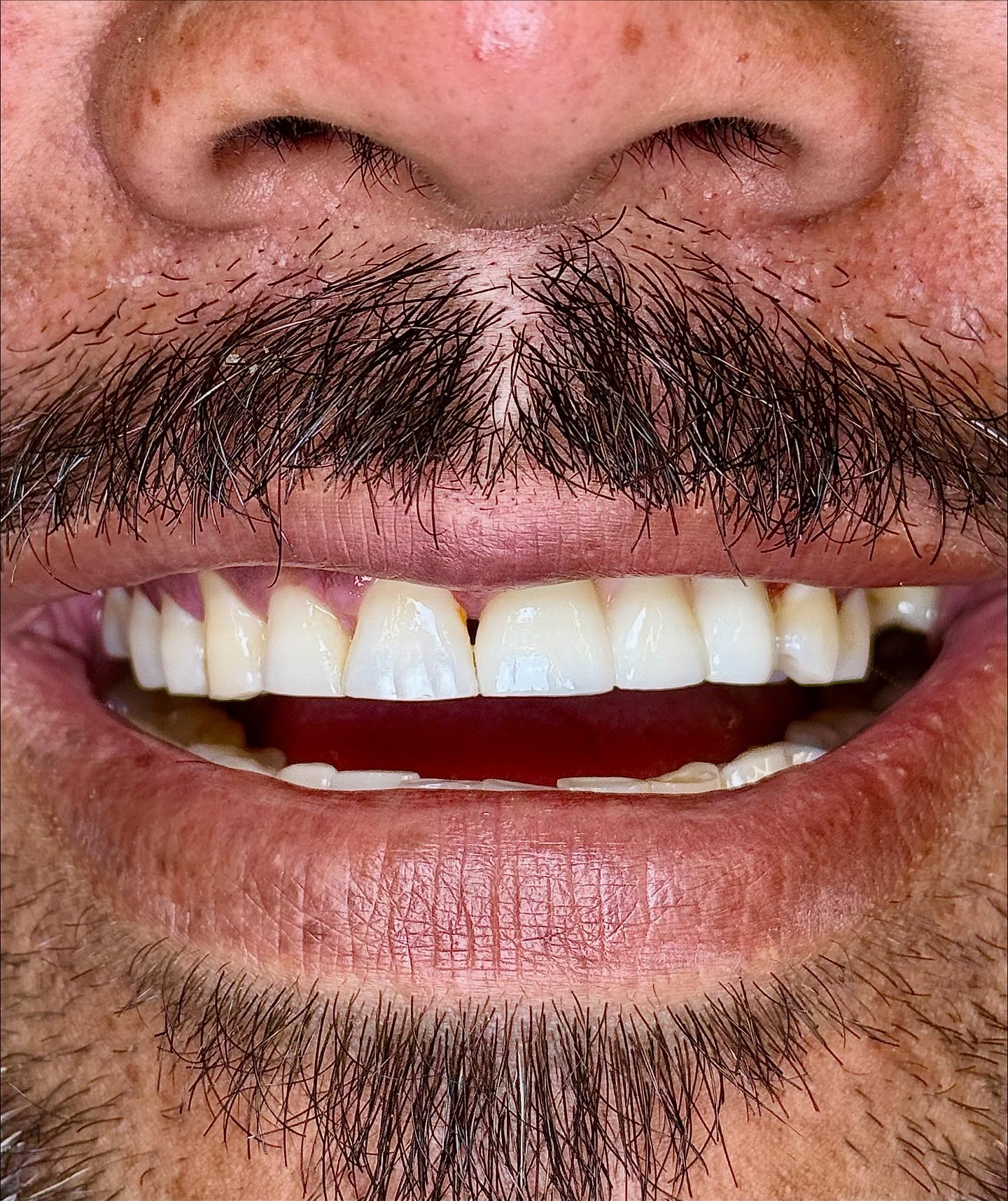 After Image: Implant Bridge - front