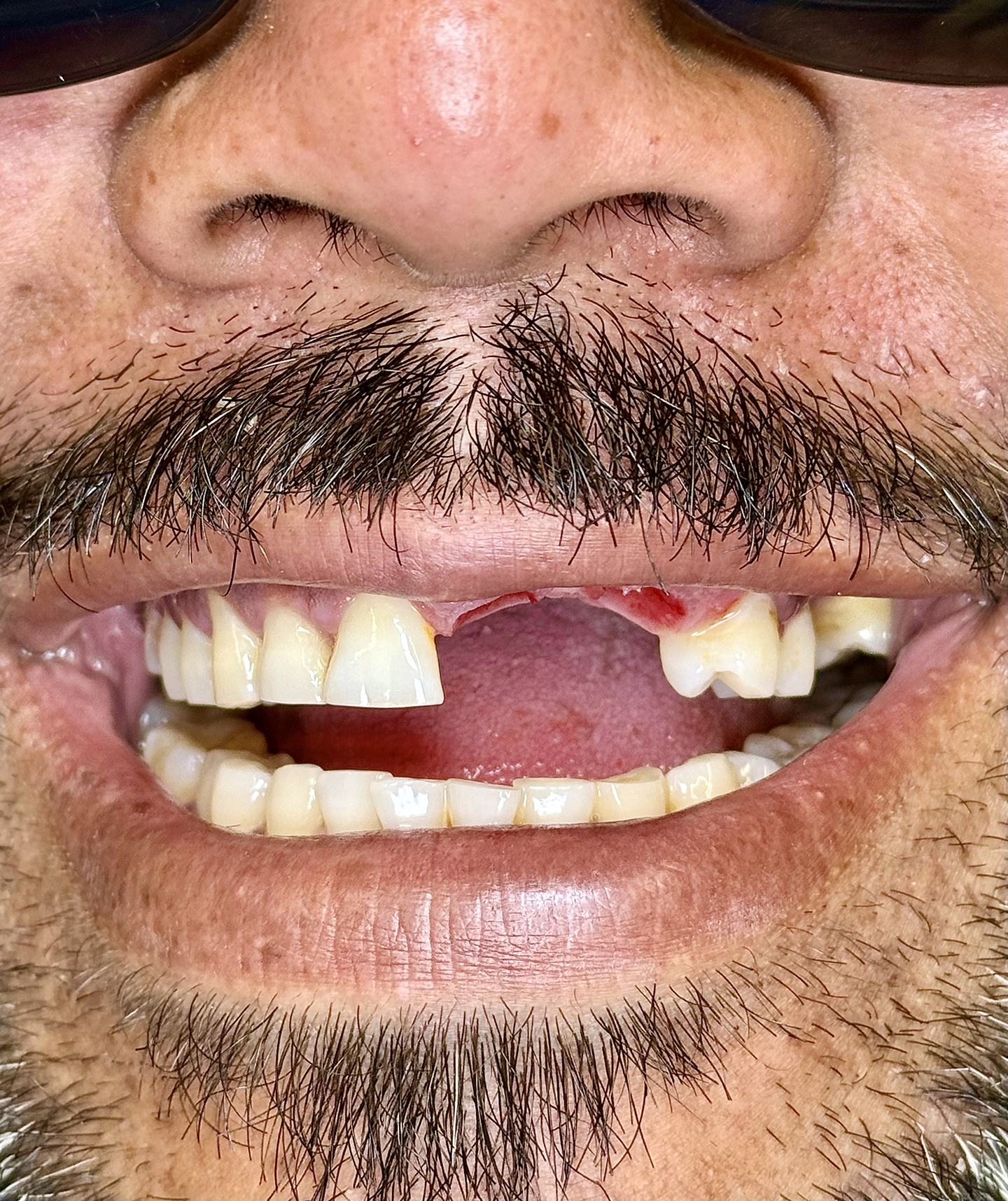 Before Image: Implant Bridge - front