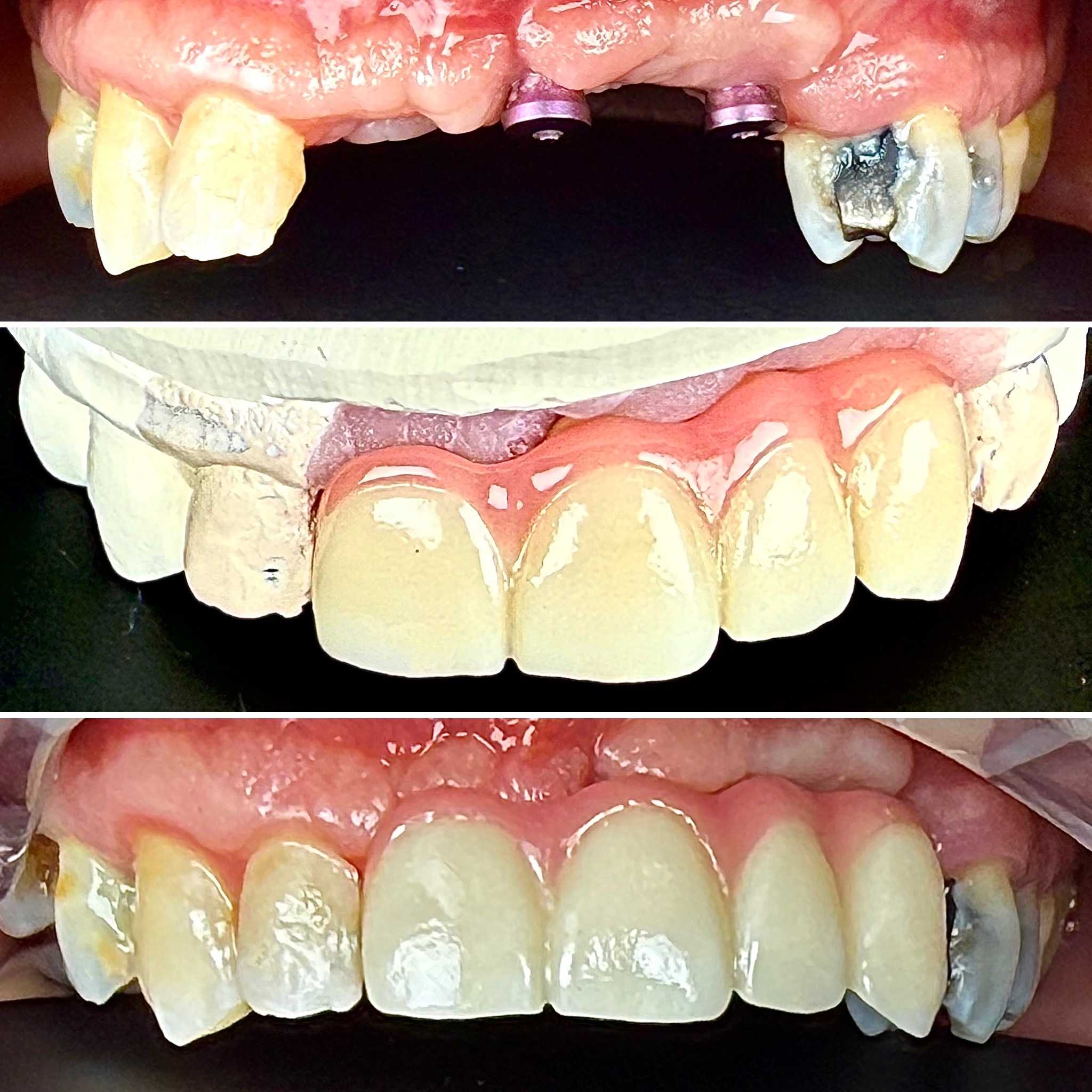 Before and After Image: Implant Bridge - front