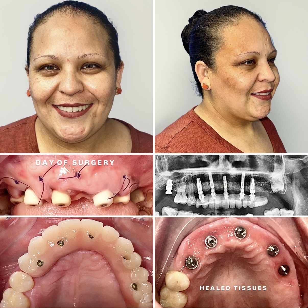 Before and After Image: Maxilla (Top) Reconstruction with Implants - front