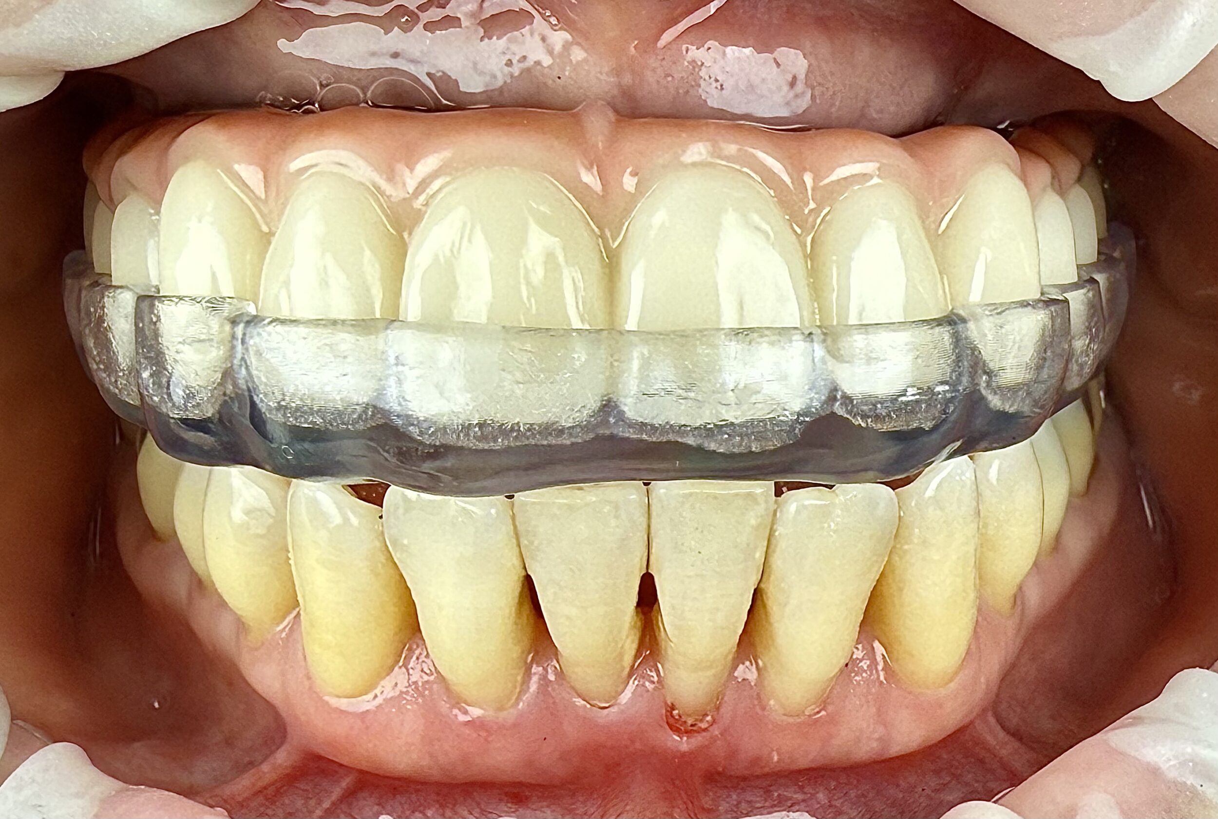 Before and After Image: NightGuards (Bite Protective Guards) - front