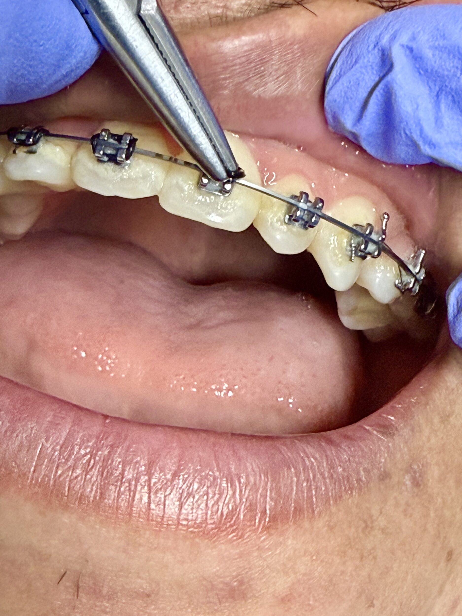 Before and After Image: Orthodontics - left-front-oblique