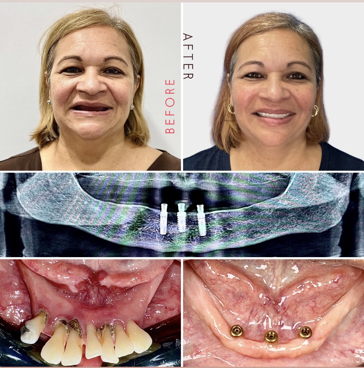 Before and After Image: Overdenture Supported in Implants - front
