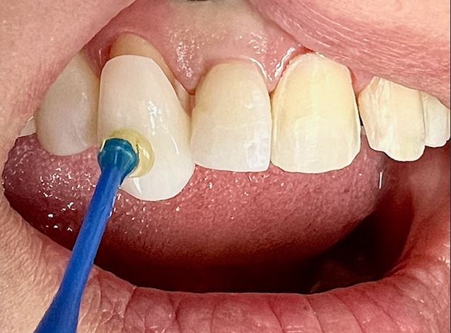 Before and After Image: Veneers - front