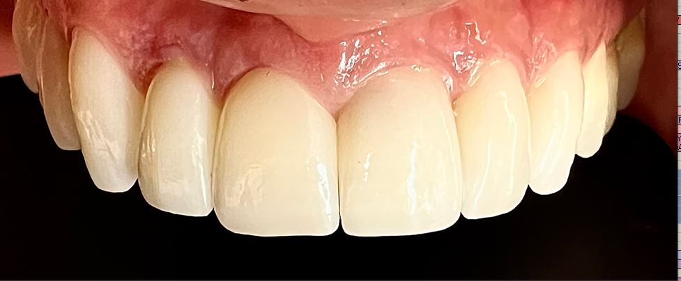 Before and After Image: Veneers - front