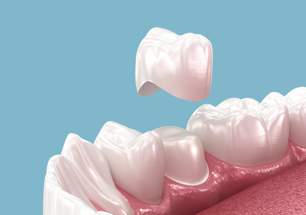 Digital rendering of a dental crown going over a weakened tooth.